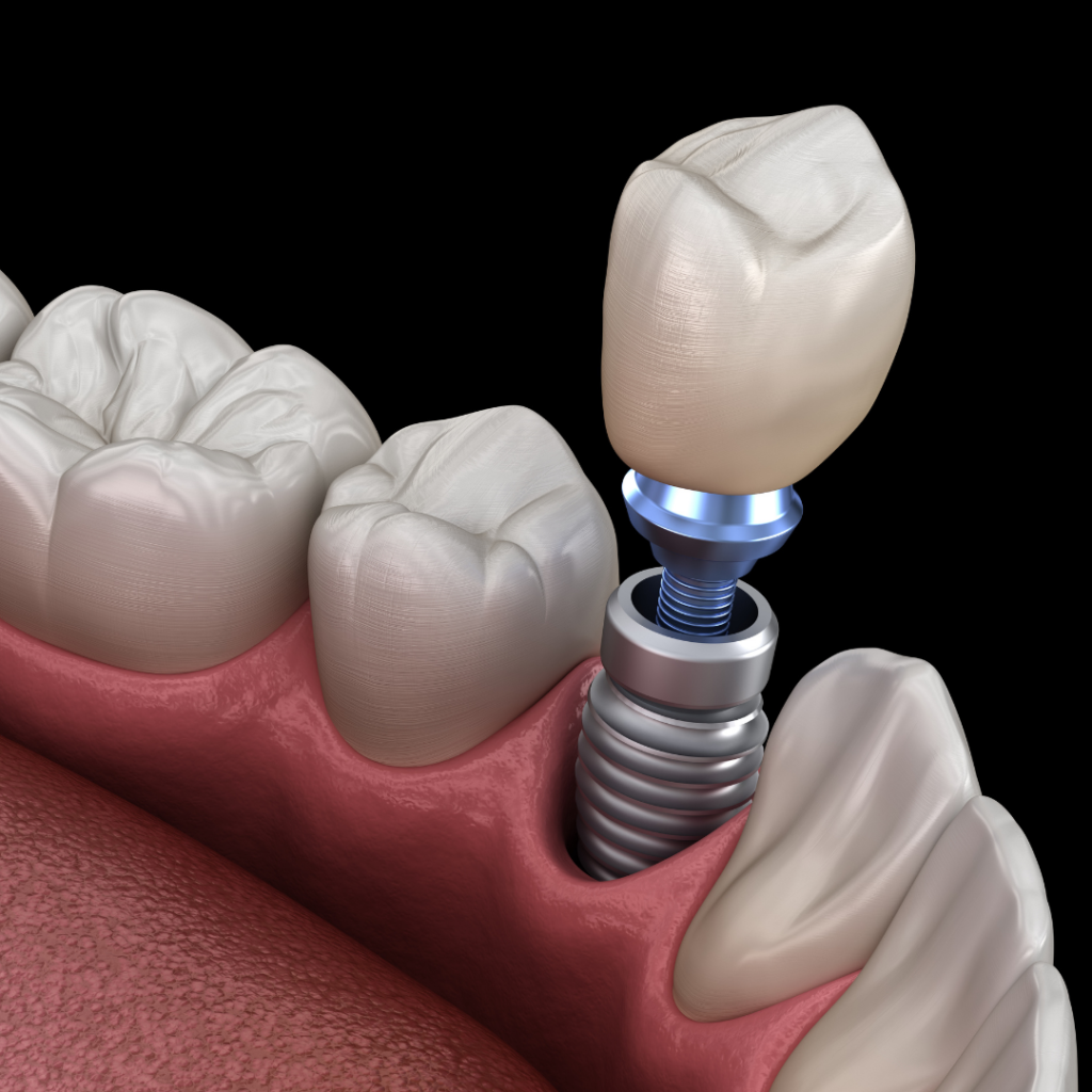 Dental Implants in Arlington