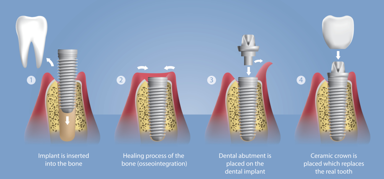 One Day Dental Implant Procedure