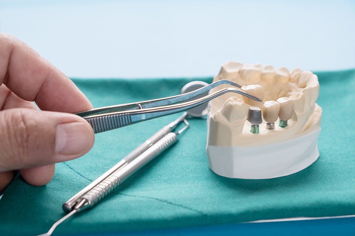 Delta Dental Implant Coverage: Will They Pay?