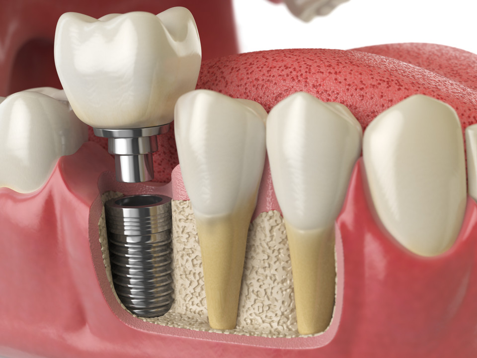 Dental Implant Contraindications: Who Should Avoid?