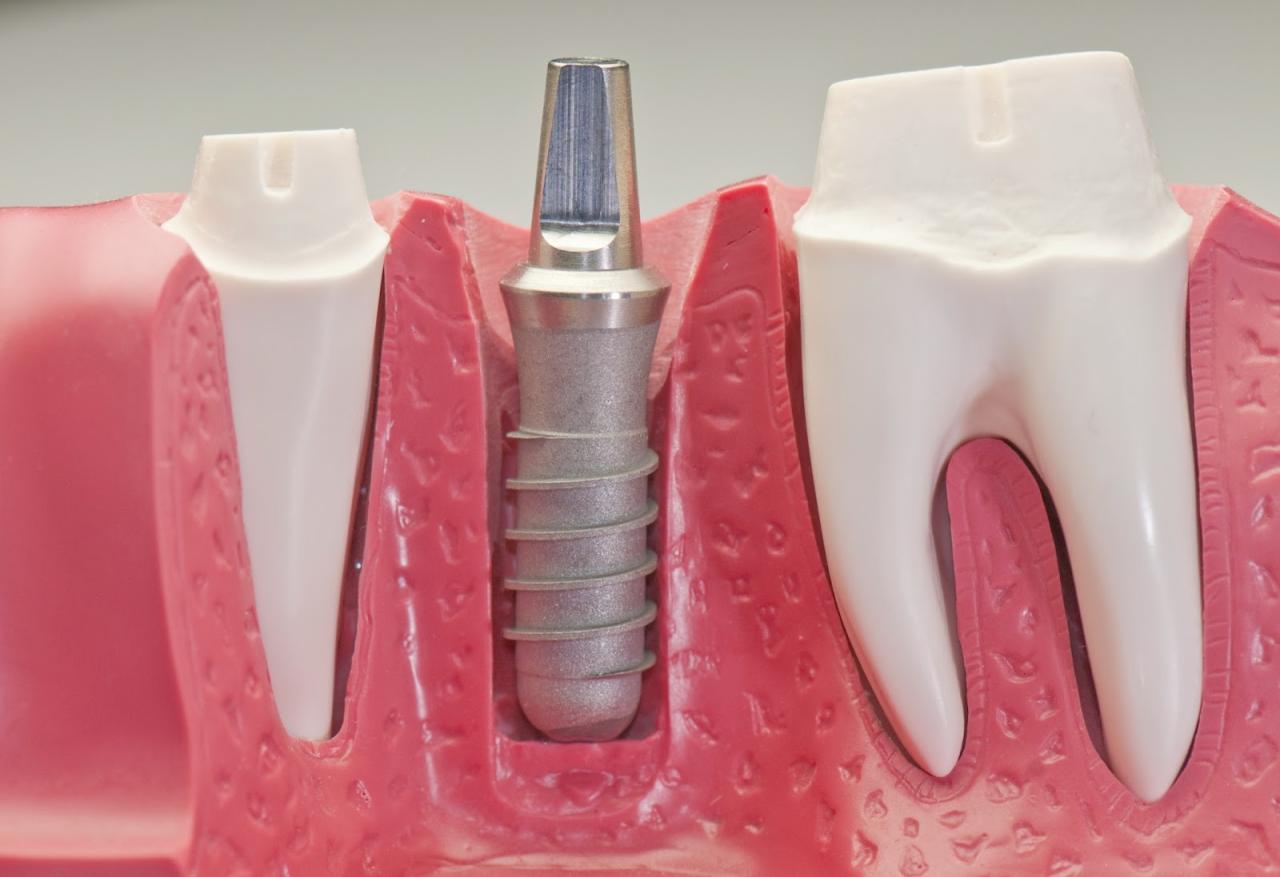 Dental Implant Normalcy: How Long Till It Feels?