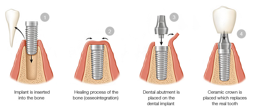 Dental Implant Process: What to Expect?
