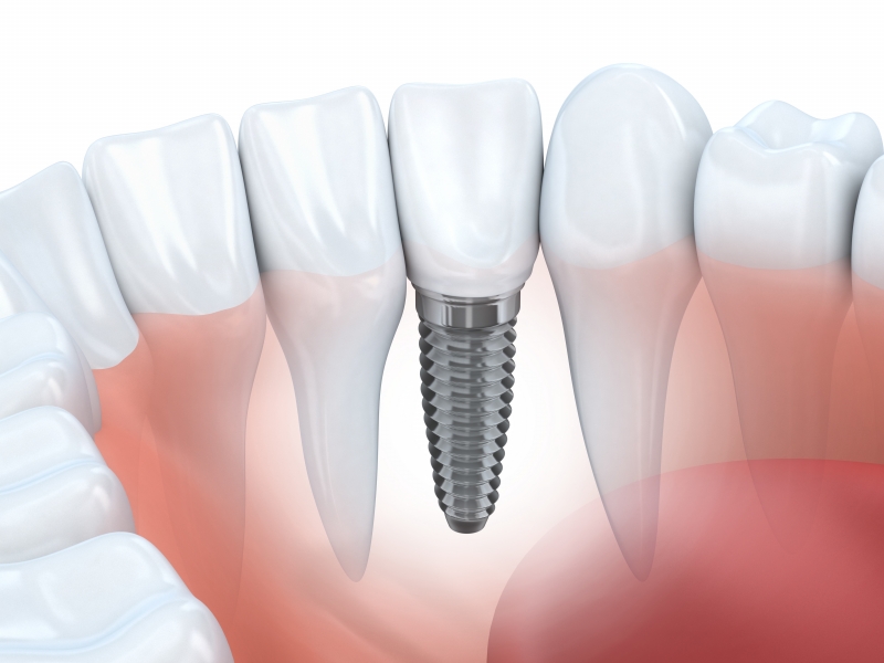 Dental Implants Feeling Natural: Do They?