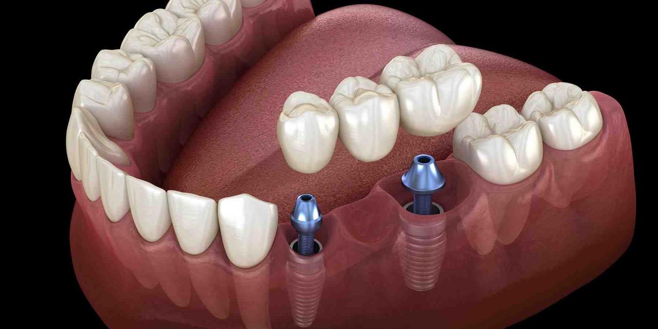 How Do Dental Implants Work?