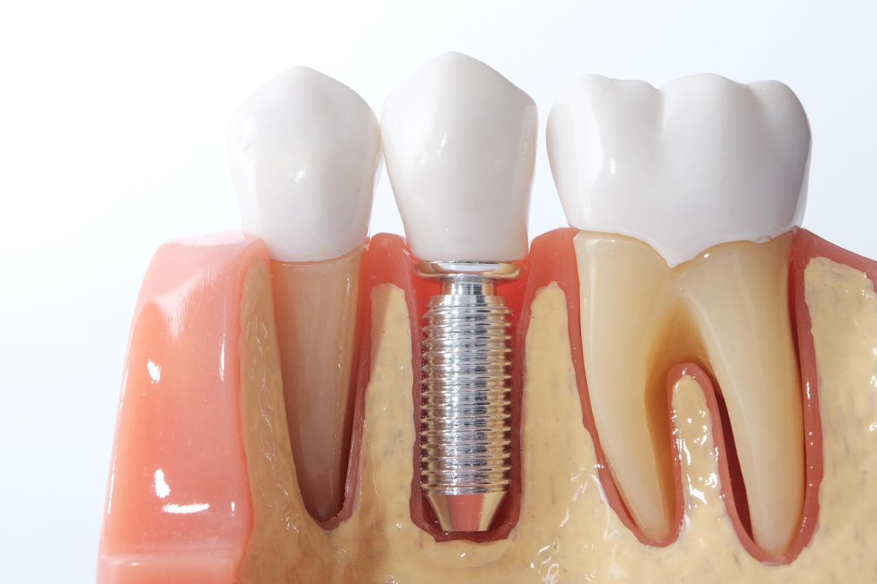 Mini Dental Implants: What Are They?