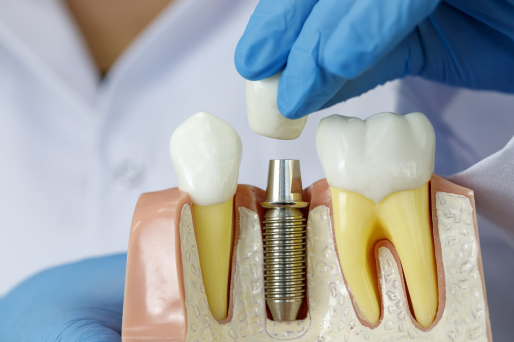 Sleep During Dental Implants Surgery: Do They?