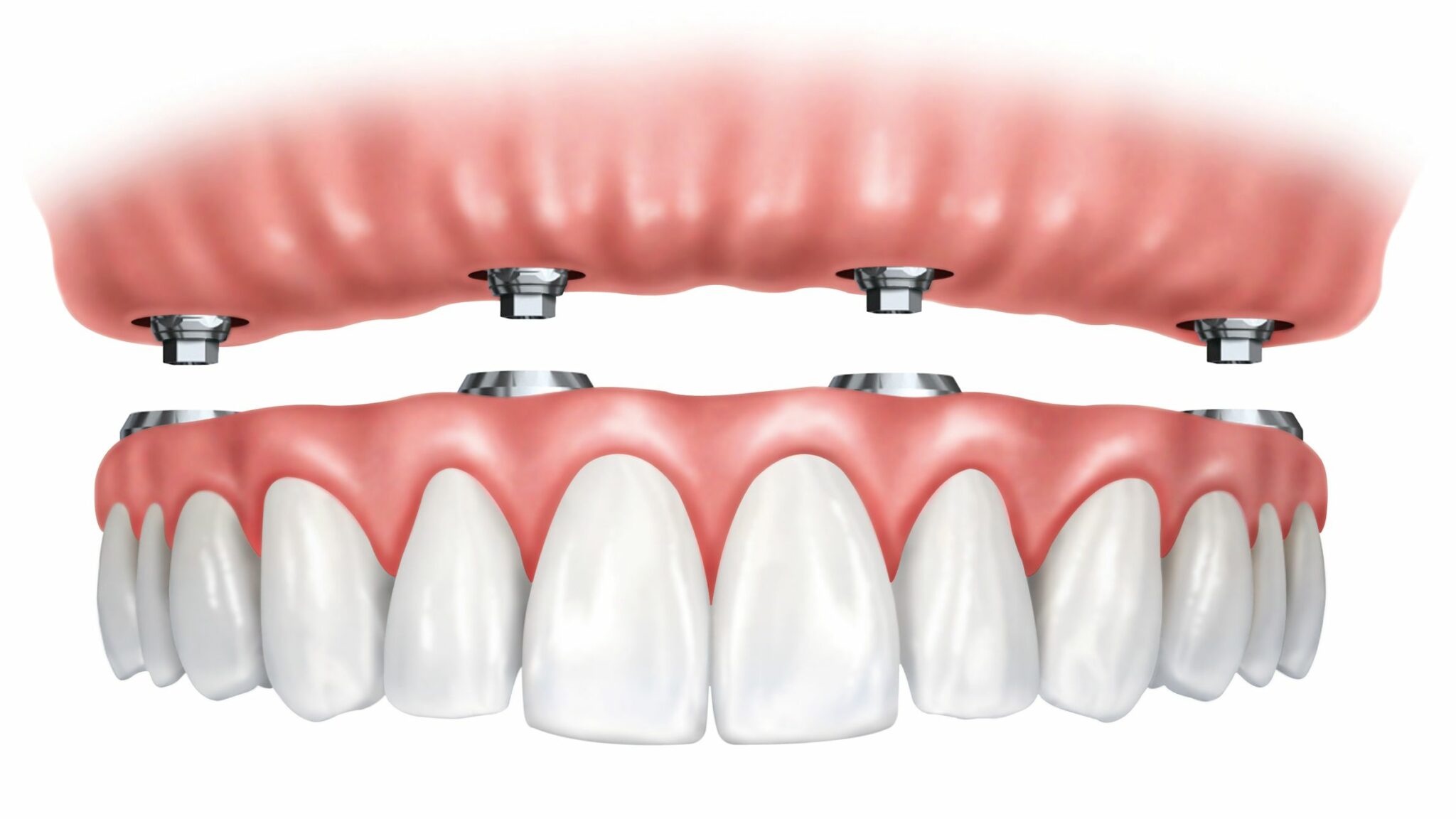 Single and Full Arch Dental Implants at Aspen Dental