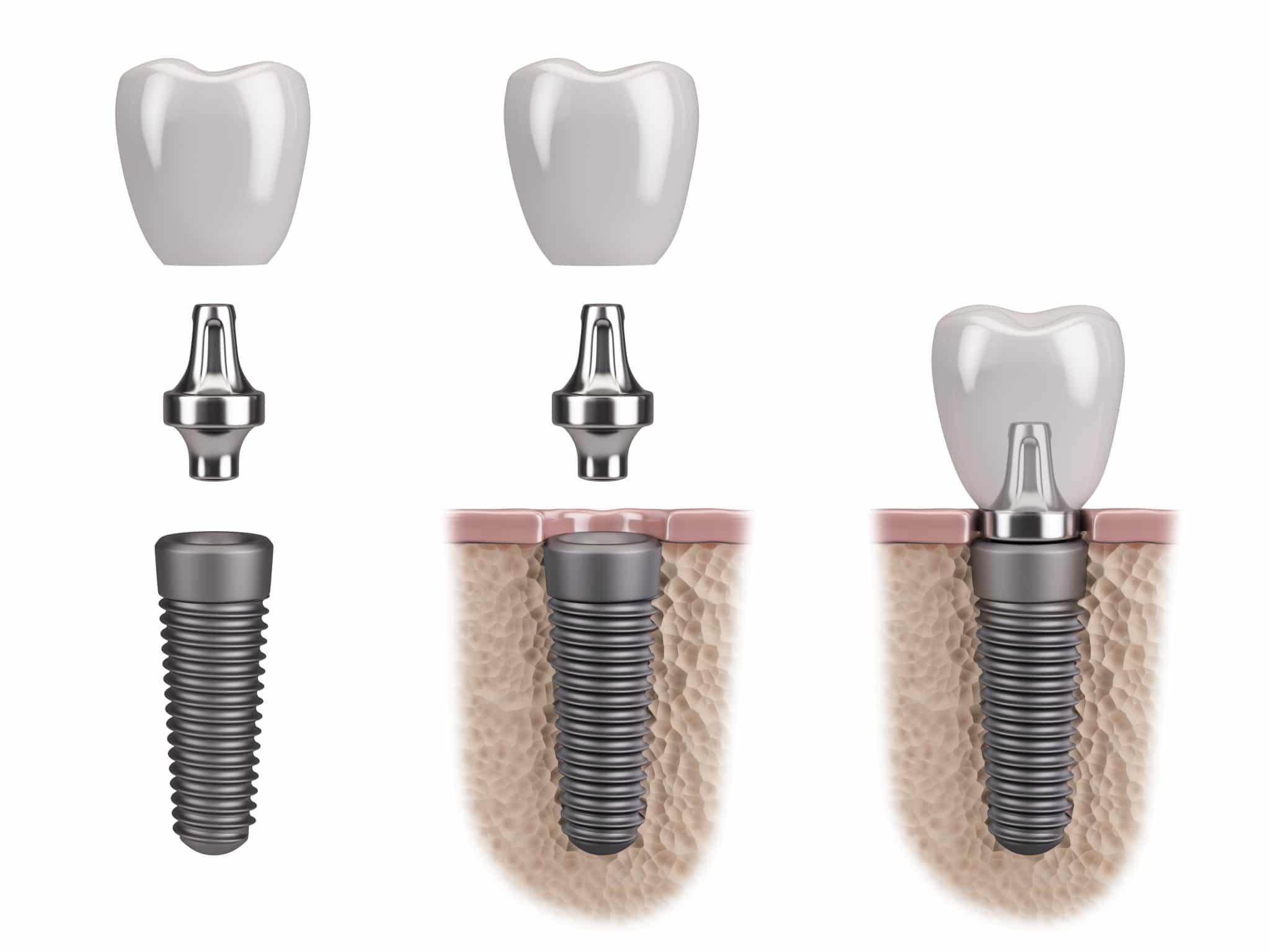 Dental Implant Anatomy