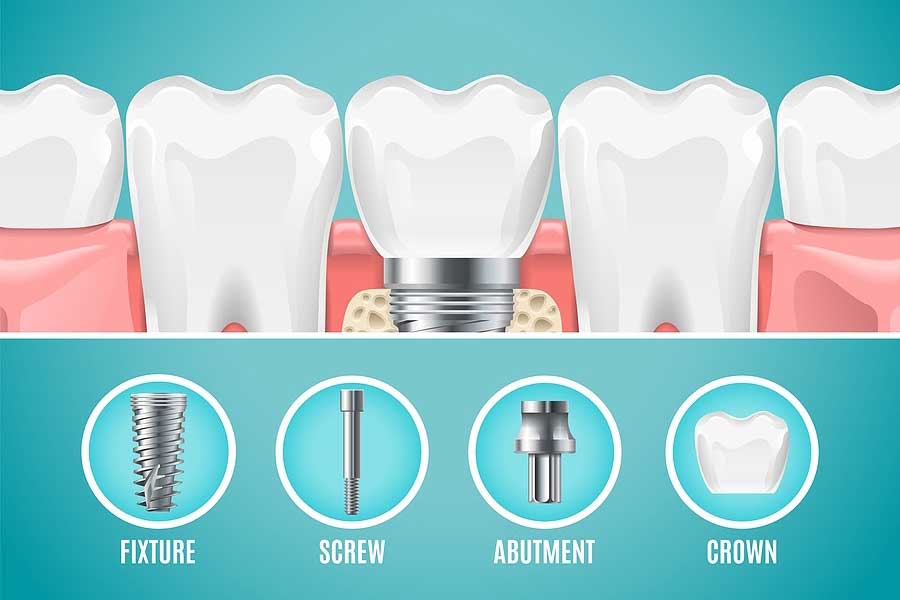 Dental Implant Cost Comparison